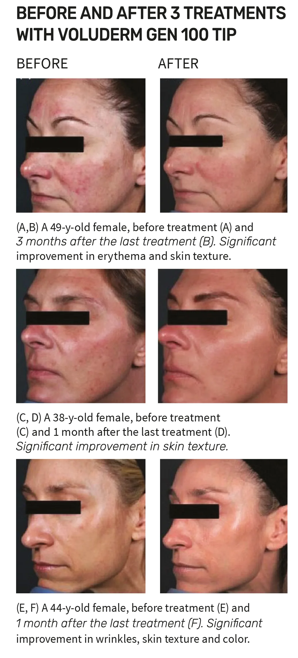 Complete Skin Rejuvenation before and after
